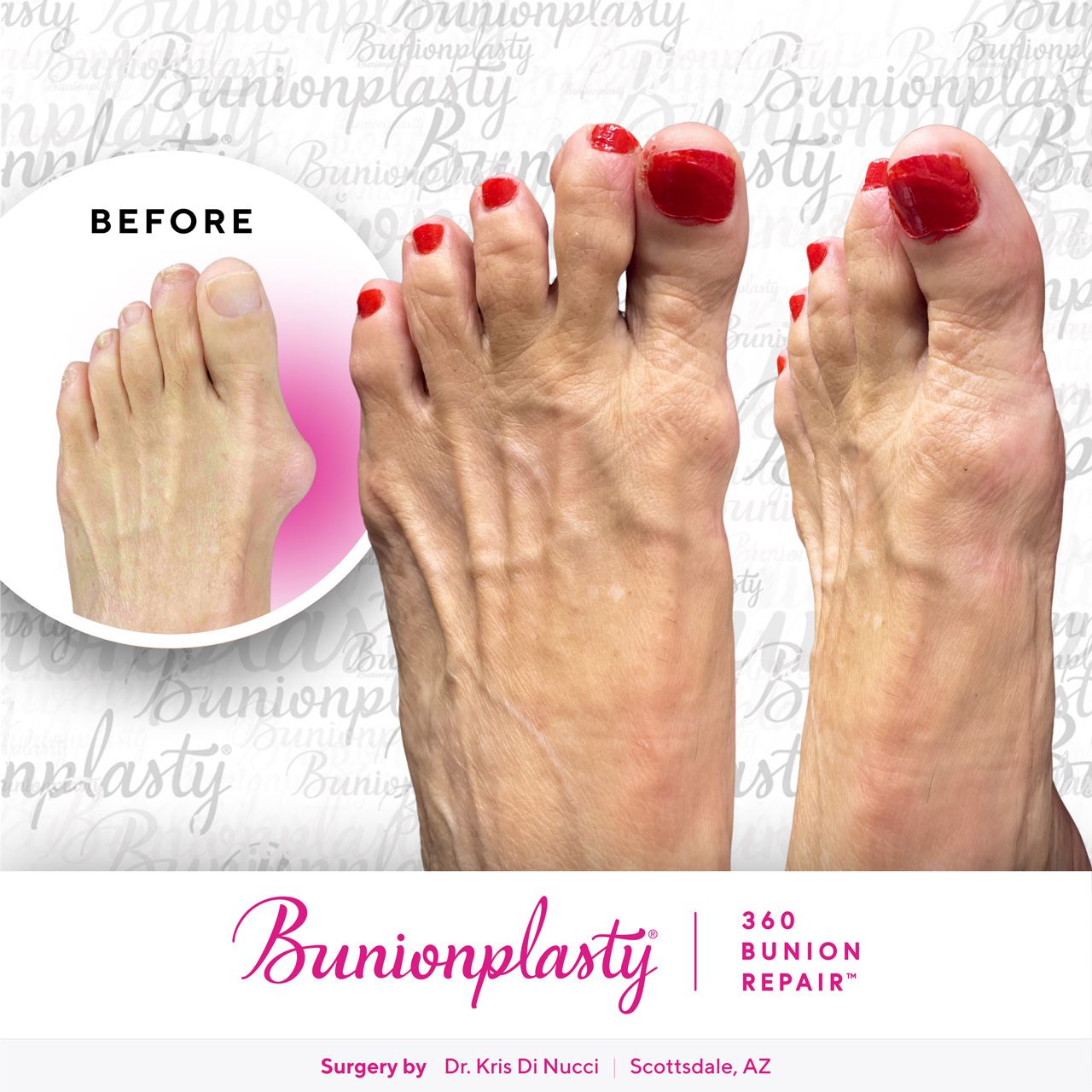 Bunionplasty® Before & After  |  Dr. Kris Di Nucci  |  Large Bunion  |  Right Foot