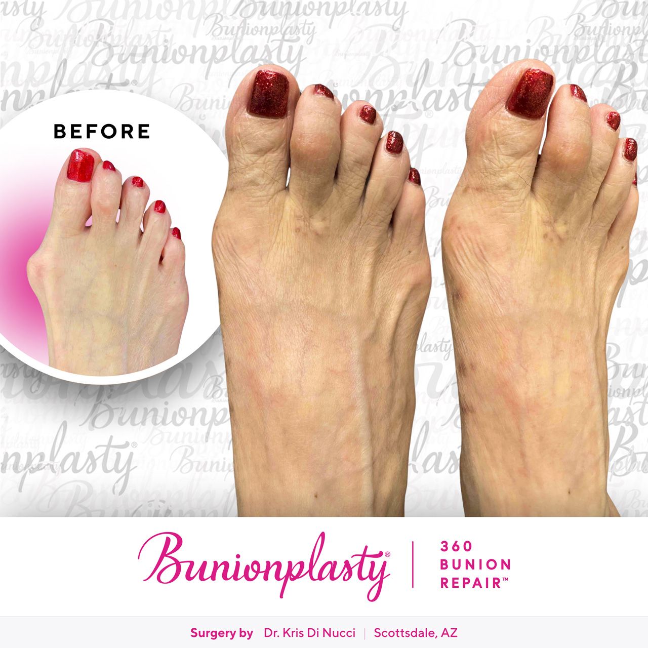 Bunionplasty® Before & After  |  Dr. Kris Di Nucci  |  Large Bunion  |  Left Foot