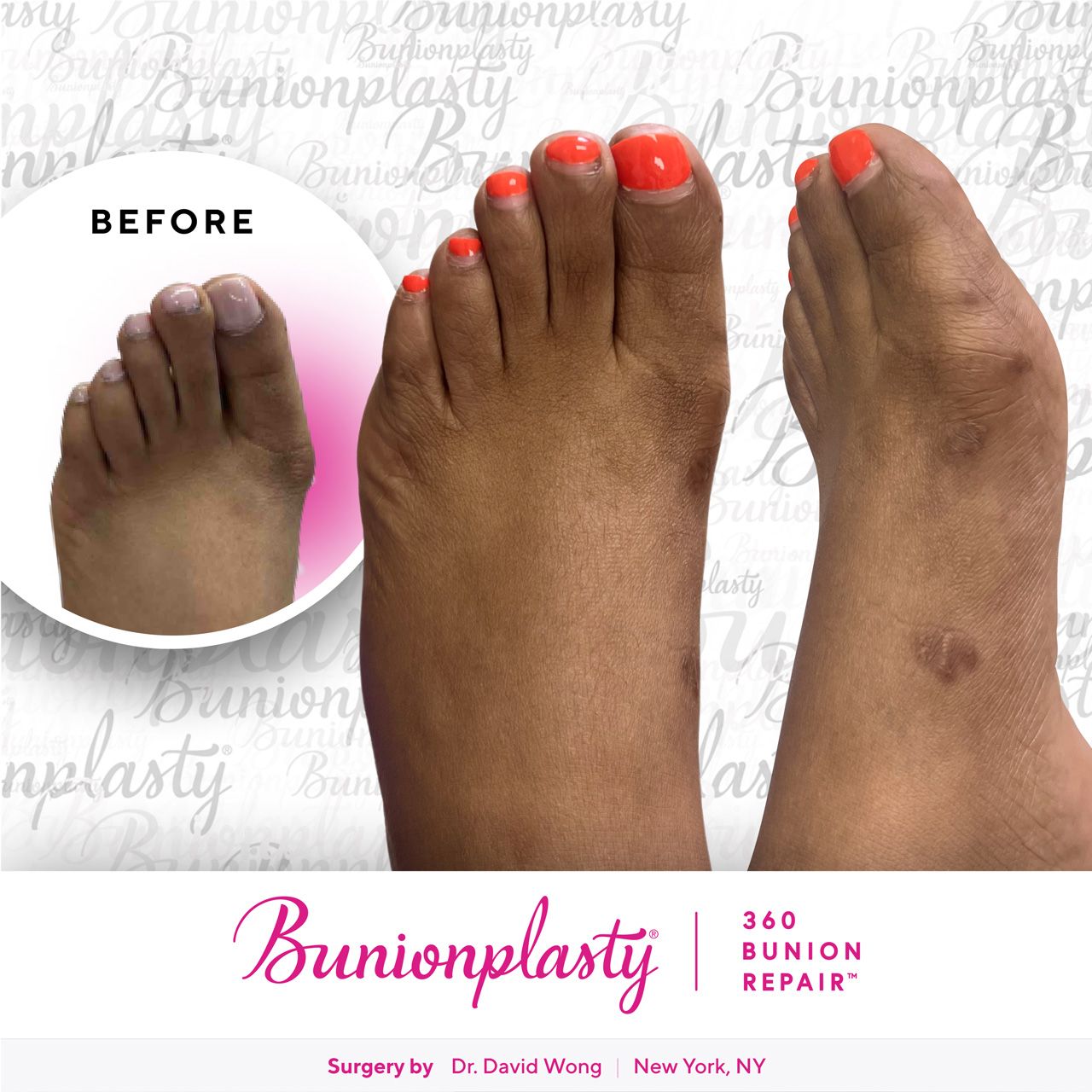 Bunionplasty® Before & After |  Mild Bunion  |  Left Foot