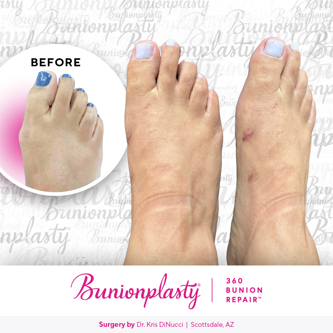 Bunionplasty® Before & After  |  Dr. Kris Di Nucci  |  Mild Bunion  |  Right Foot
