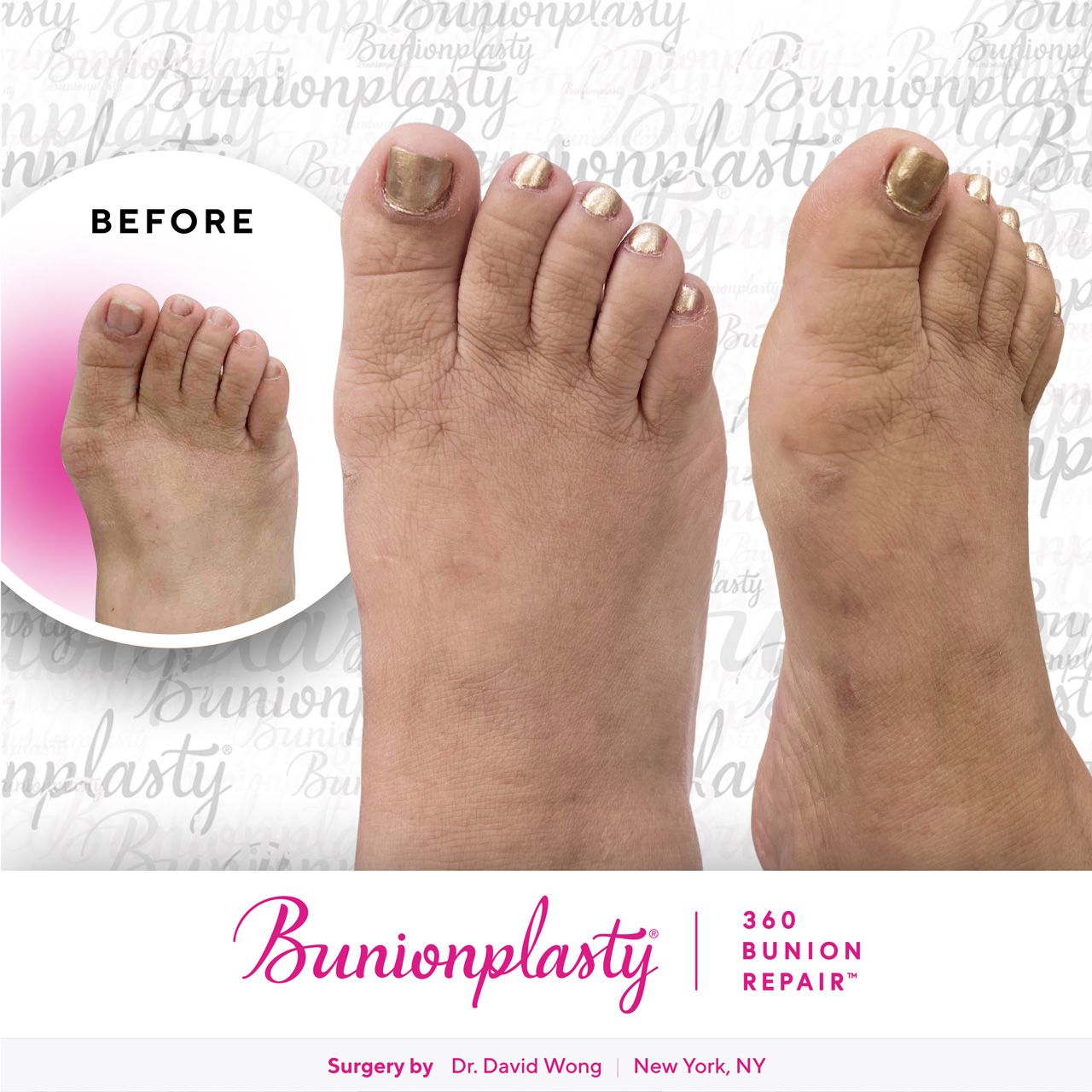 Bunionplasty® Before & After |  Mild Bunion  |  Right Foot