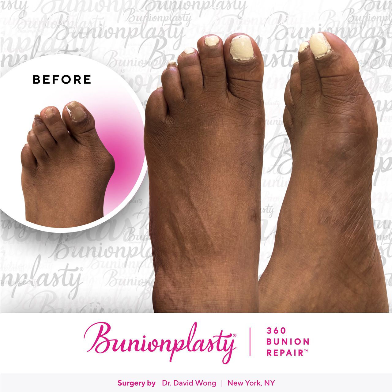 Bunionplasty® Before & After |  Dr. David Wong  |  Severe Bunion  |  Left Foot