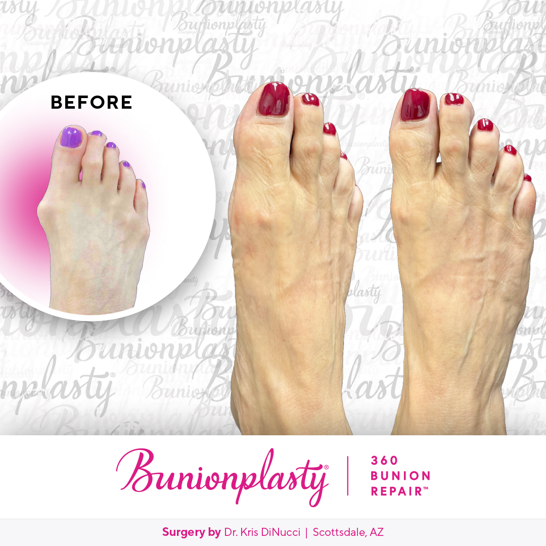 Bunionplasty® Before & After  |  Dr. Kris Di Nucci  |  Large Bunion  |  Right Foot