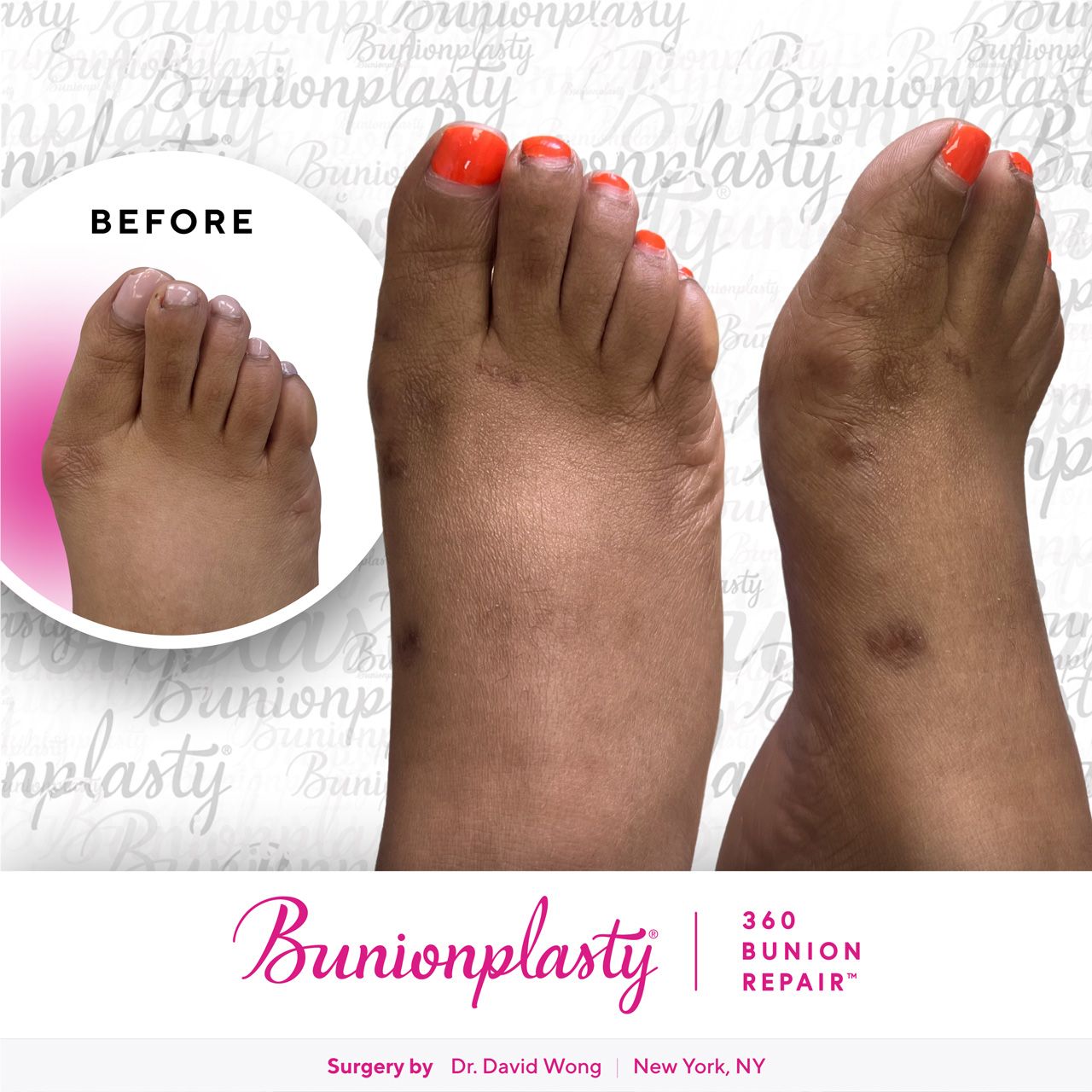 Bunionplasty® Before & After |  Large Bunion  |  Right Foot