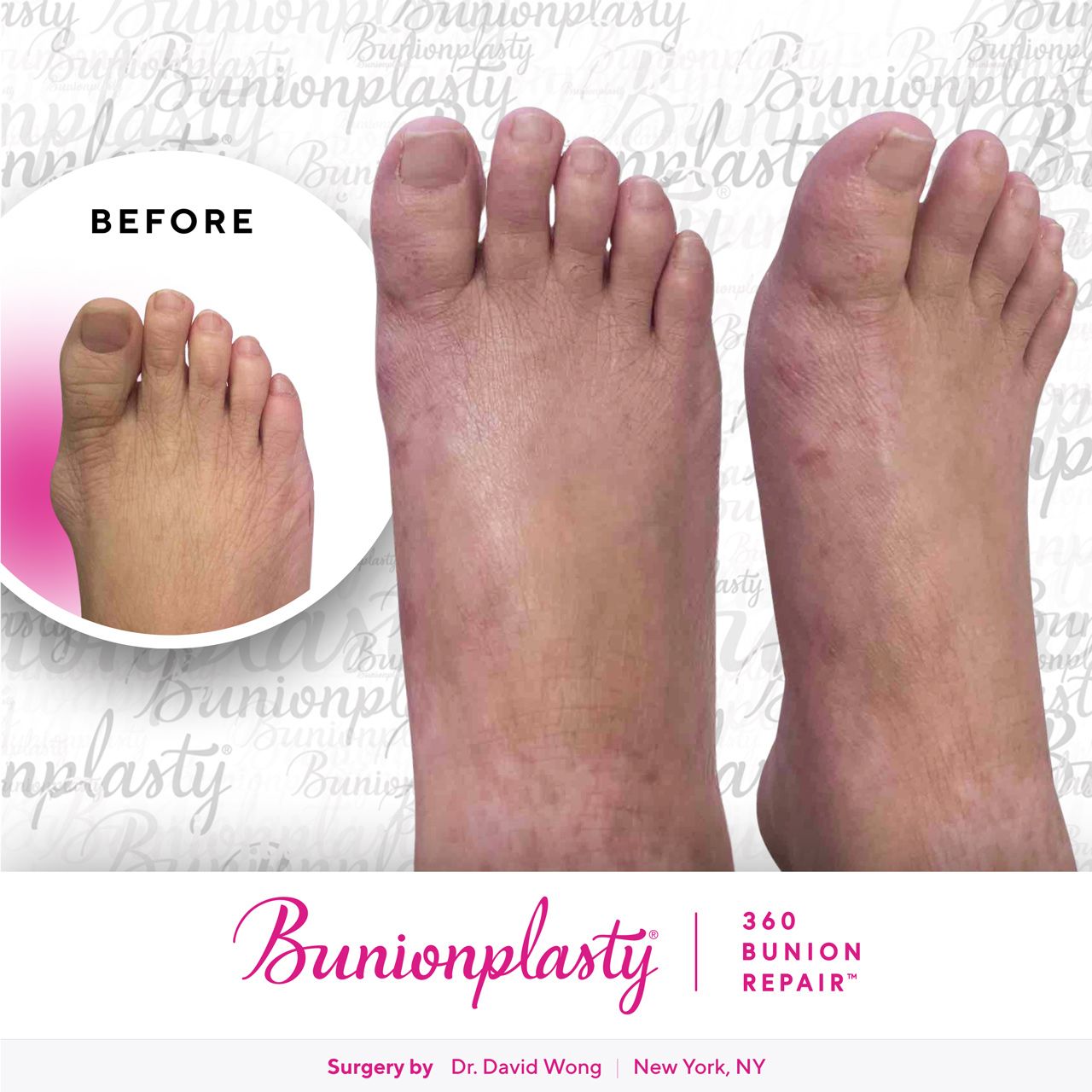 Bunionplasty® Before & After |  Dr. David Wong  |  Mild Bunion  |  Right Foot