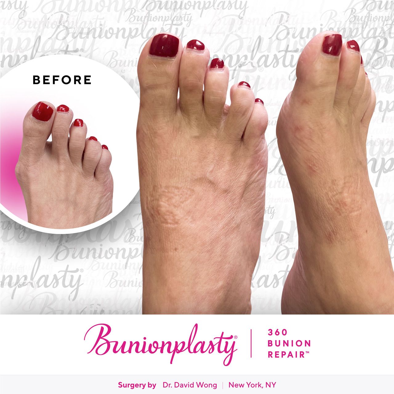 Bunionplasty® Before & After |  Dr. David Wong  |  Mild Bunion  |  Right Foot