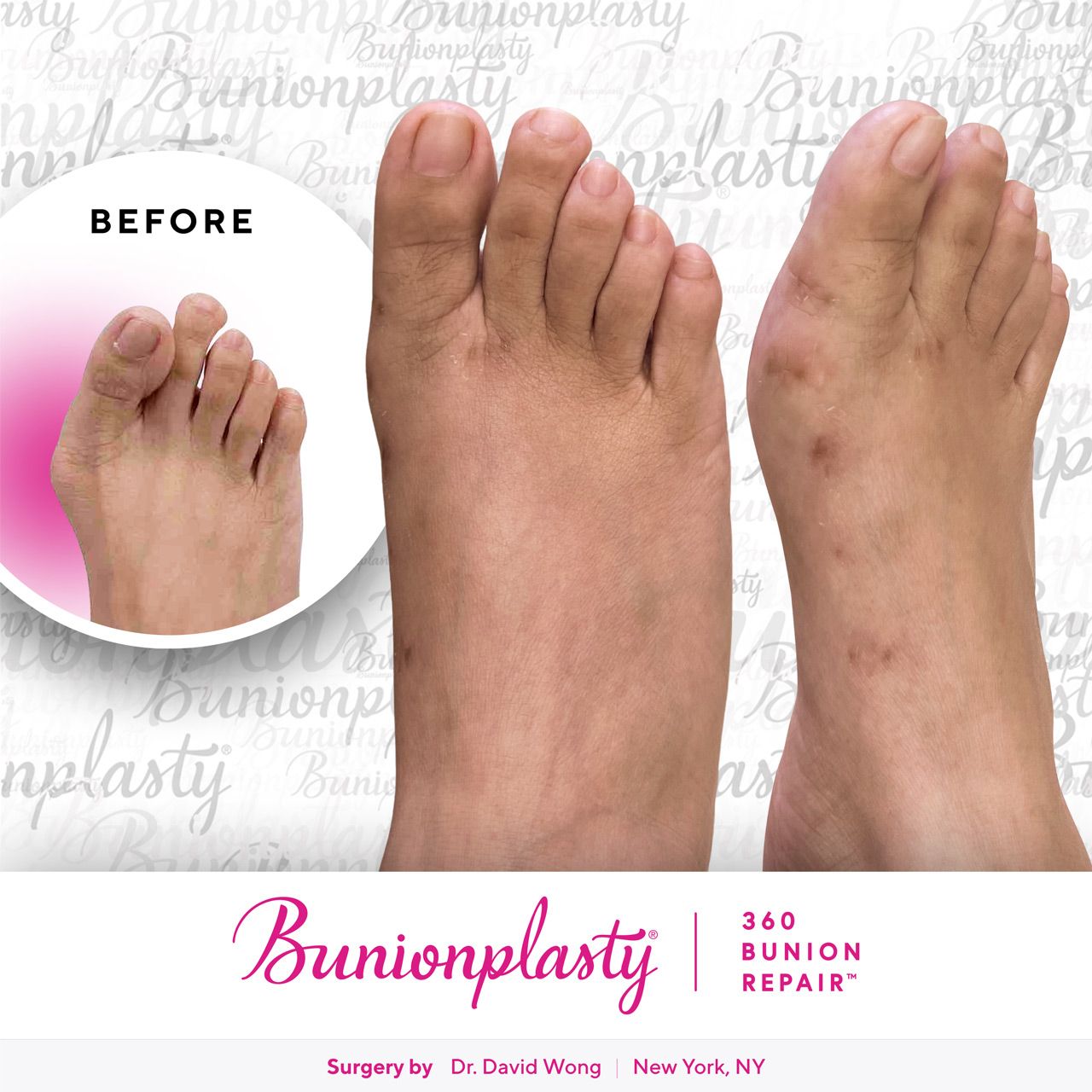 Bunionplasty® Before & After |  Dr. David Wong  |  Severe Bunion  |  Right Foot