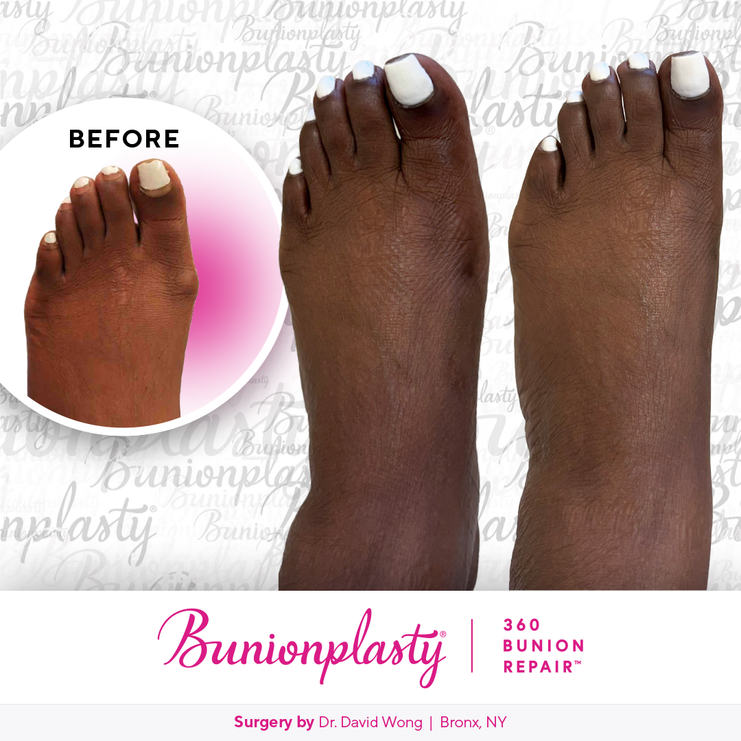 Bunionplasty® Before & After |  Dr. David Wong  |  Mild Bunion  |  Left Foot