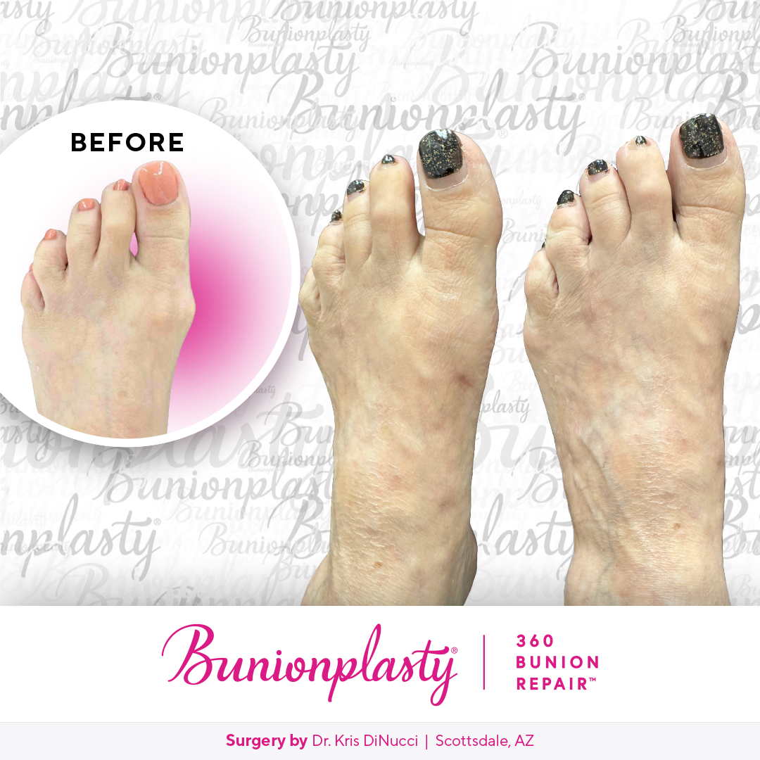 Bunionplasty® Before & After  |  Dr. Kris Di Nucci  |  Large Bunion  |  Left Foot