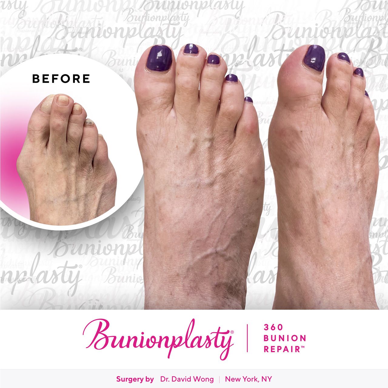 Bunionplasty® Before & After |  Dr. David Wong  |  Severe Bunion  |  Right Foot