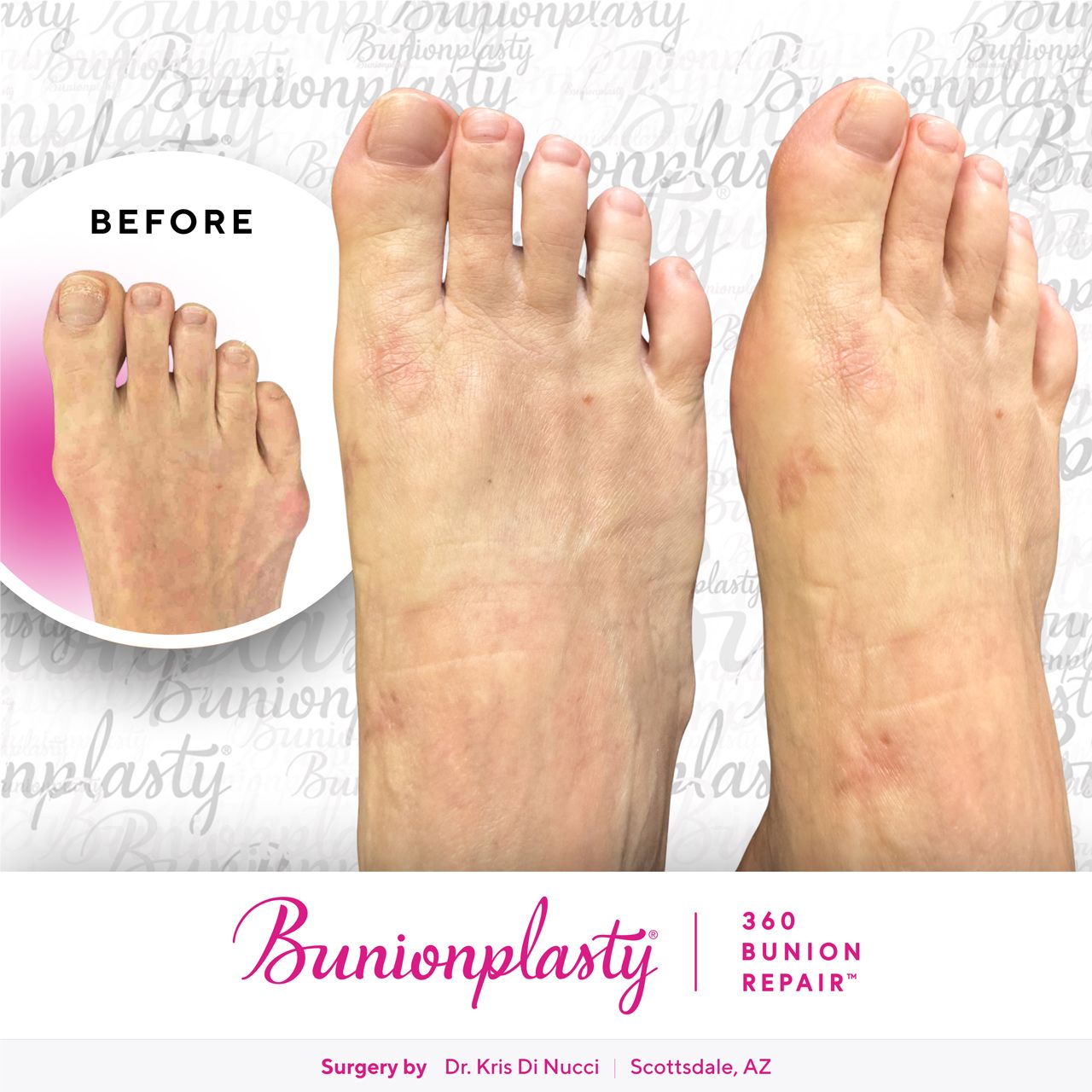 Bunionplasty® Before & After  |  Dr. Kris Di Nucci  |  Mild Bunion  |  Right Foot