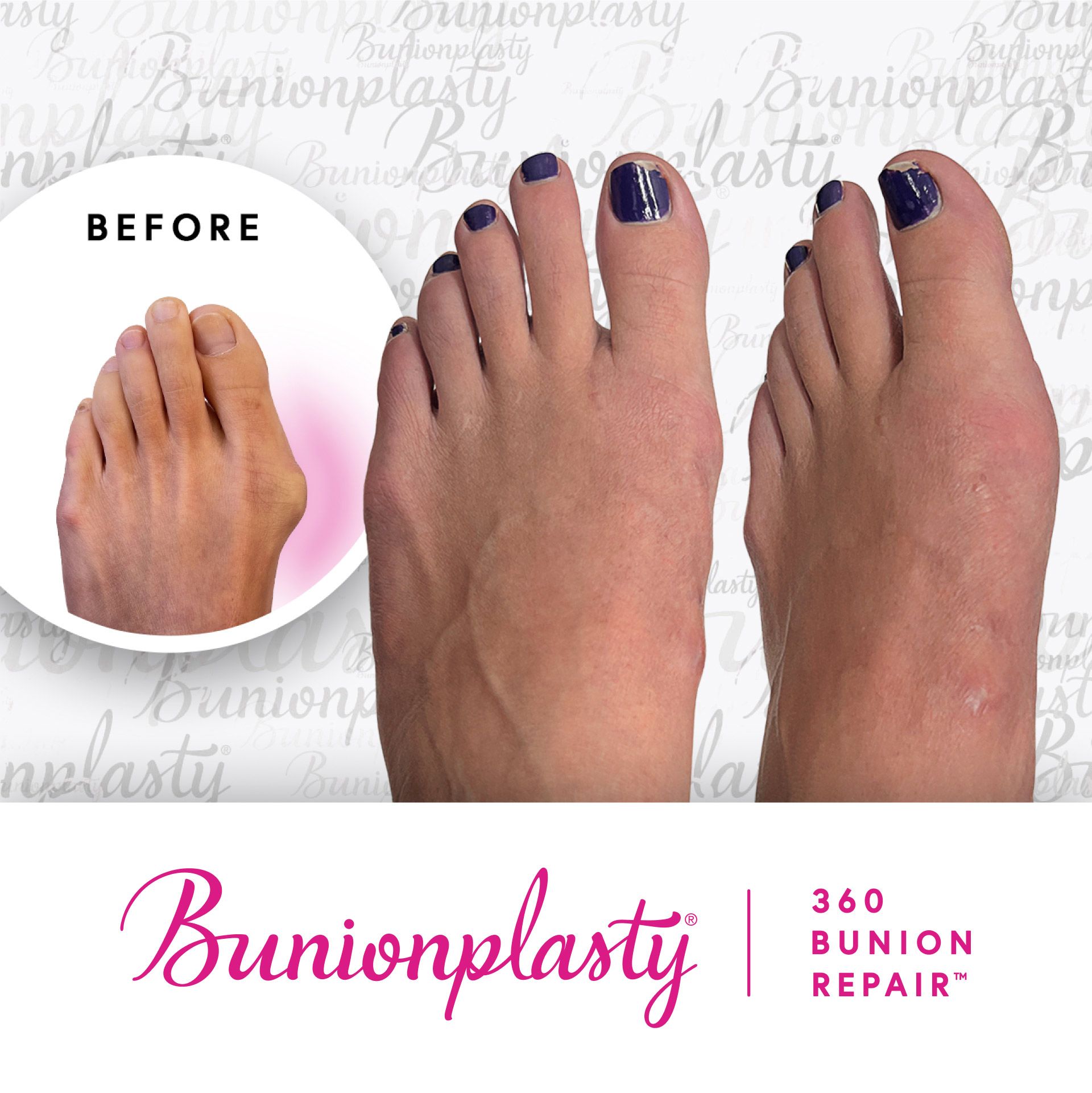 Bunionplasty® Before & After |  Large Bunion | Left Foot