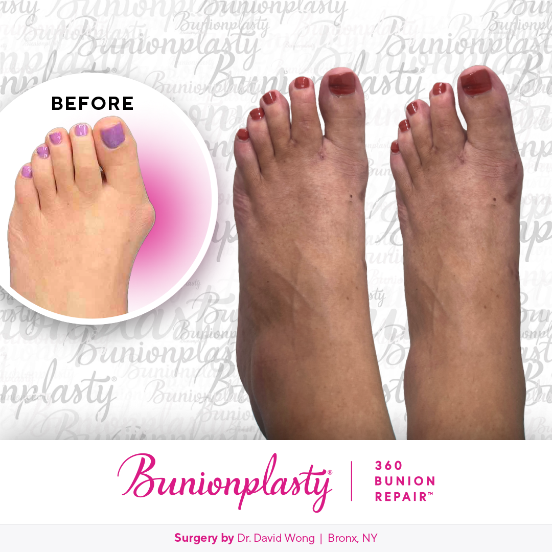 Bunionplasty® Before & After  |  Dr. David Wong |  Large Bunion  |  Left Foot