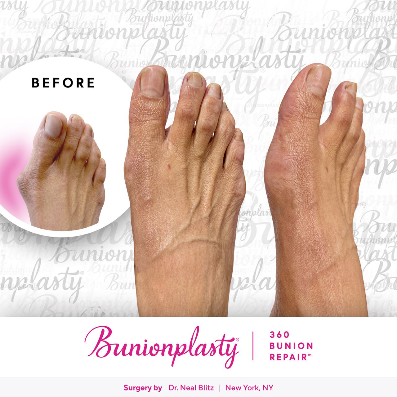 Bunionplasty® Before & After |  Large Bunion  |  Right Foot