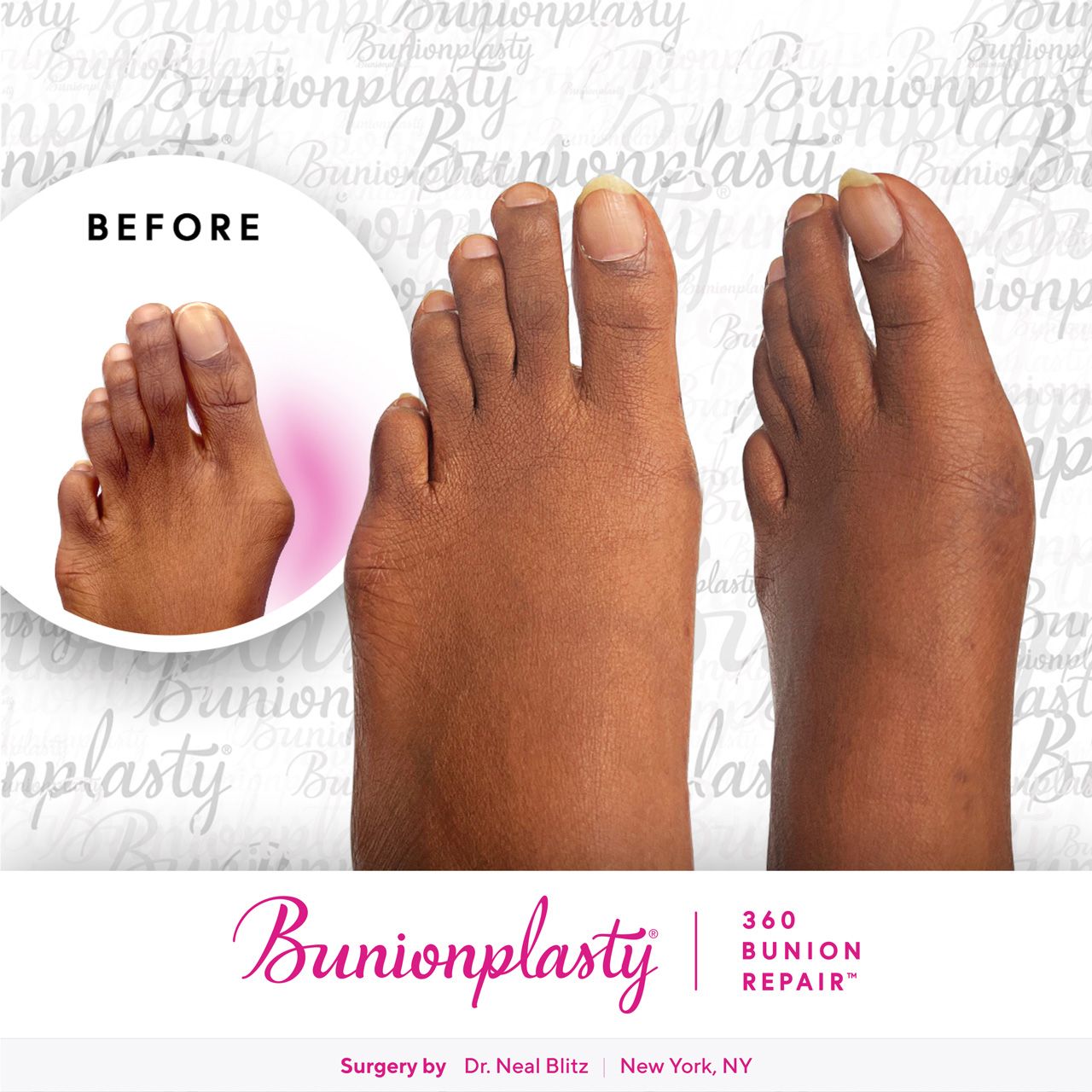 Bunionplasty® Before & After |  Large Bunion  |  Left Foot