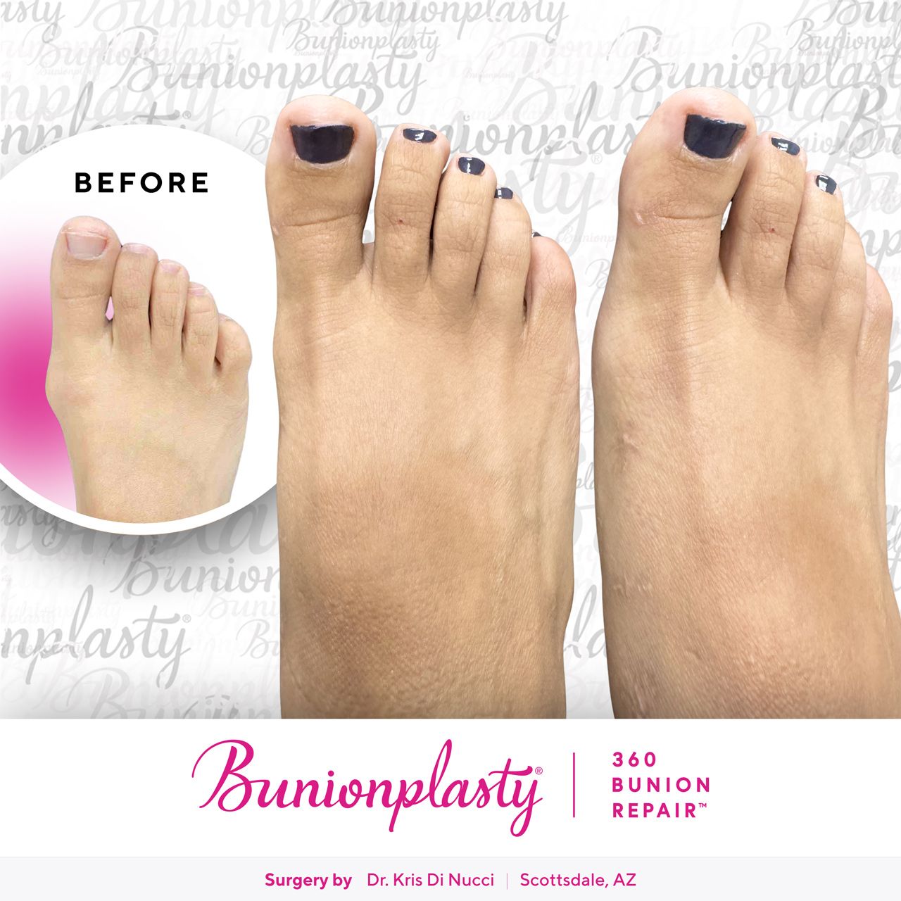 Bunionplasty® Before & After  |  Dr. Kris Di Nucci  |  Mild Bunion  |  Right Foot