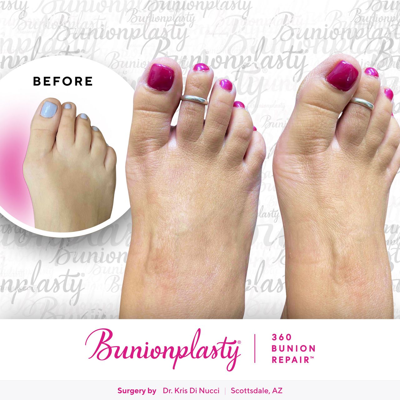 Bunionplasty® Before & After  |  Dr. Kris Di Nucci  |  Mild Bunion  |  Right Foot