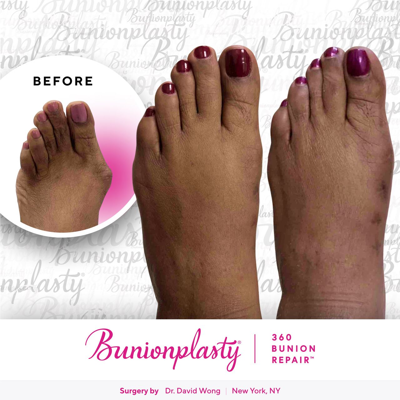 Bunionplasty® Before & After |  Dr. David Wong  |  Large Bunion  |  Left Foot