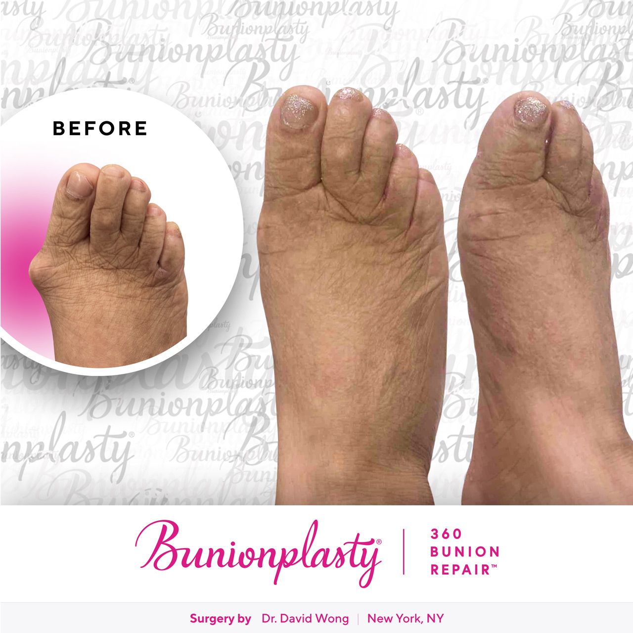 Bunionplasty® Before & After |  Dr. David Wong  |  Large Bunion  |  Right Foot