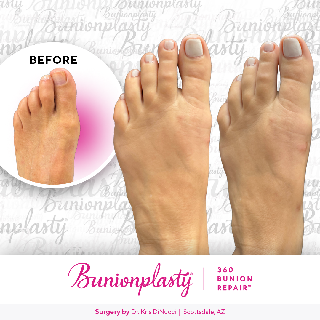 Bunionplasty® Before & After  |  Dr. Kris Di Nucci  |  Mild Bunion  |  Left Foot