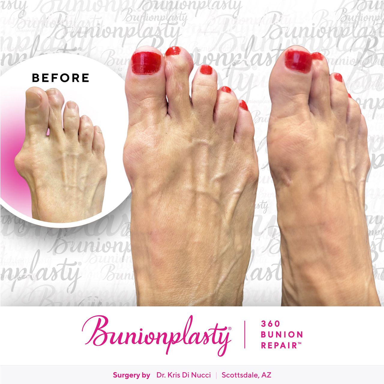 Bunionplasty® Before & After  |  Dr. Kris Di Nucci  |  Large Bunion  |  Right Foot