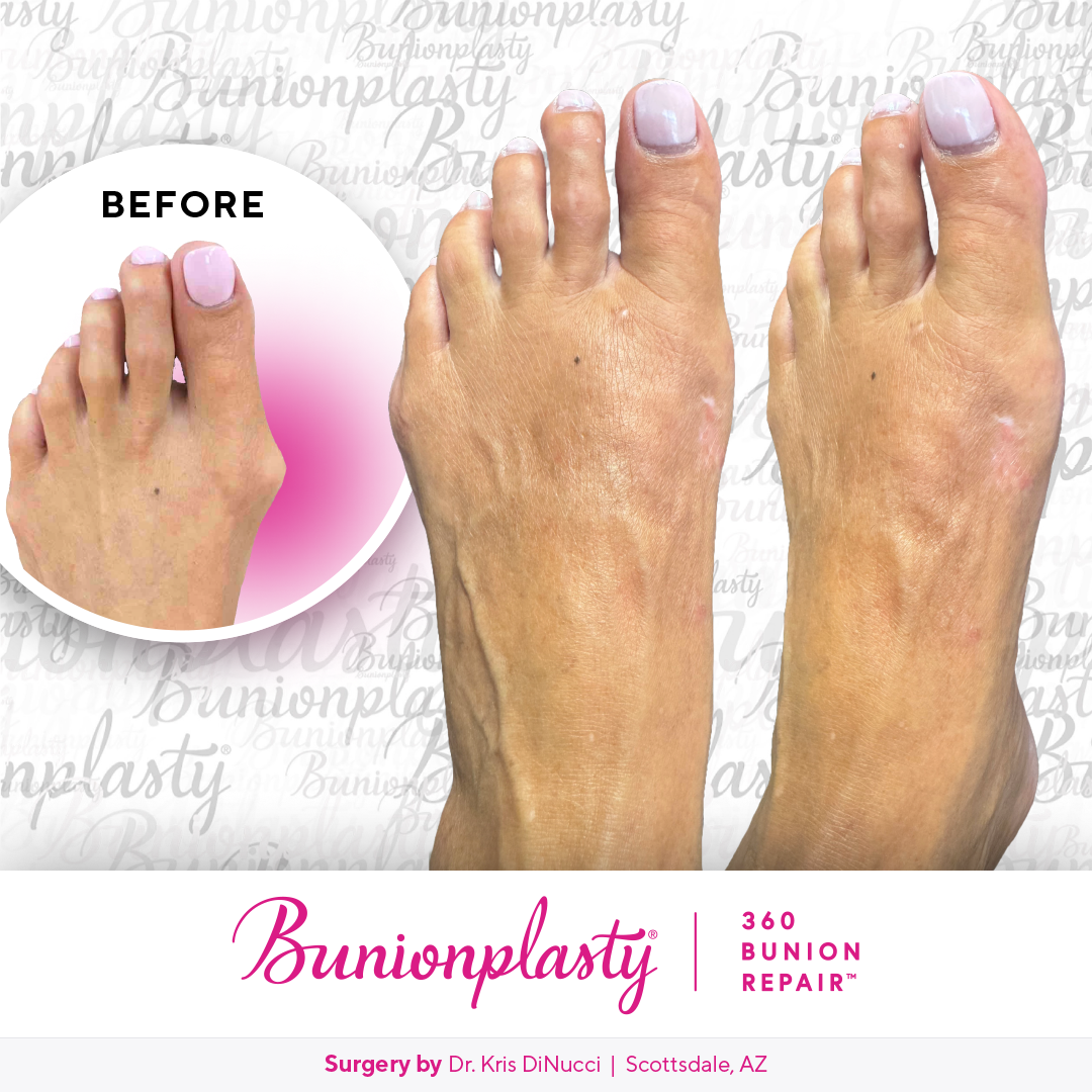 Bunionplasty® Before & After  |  Dr. Kris Di Nucci  |  Large Bunion  |  Left Foot