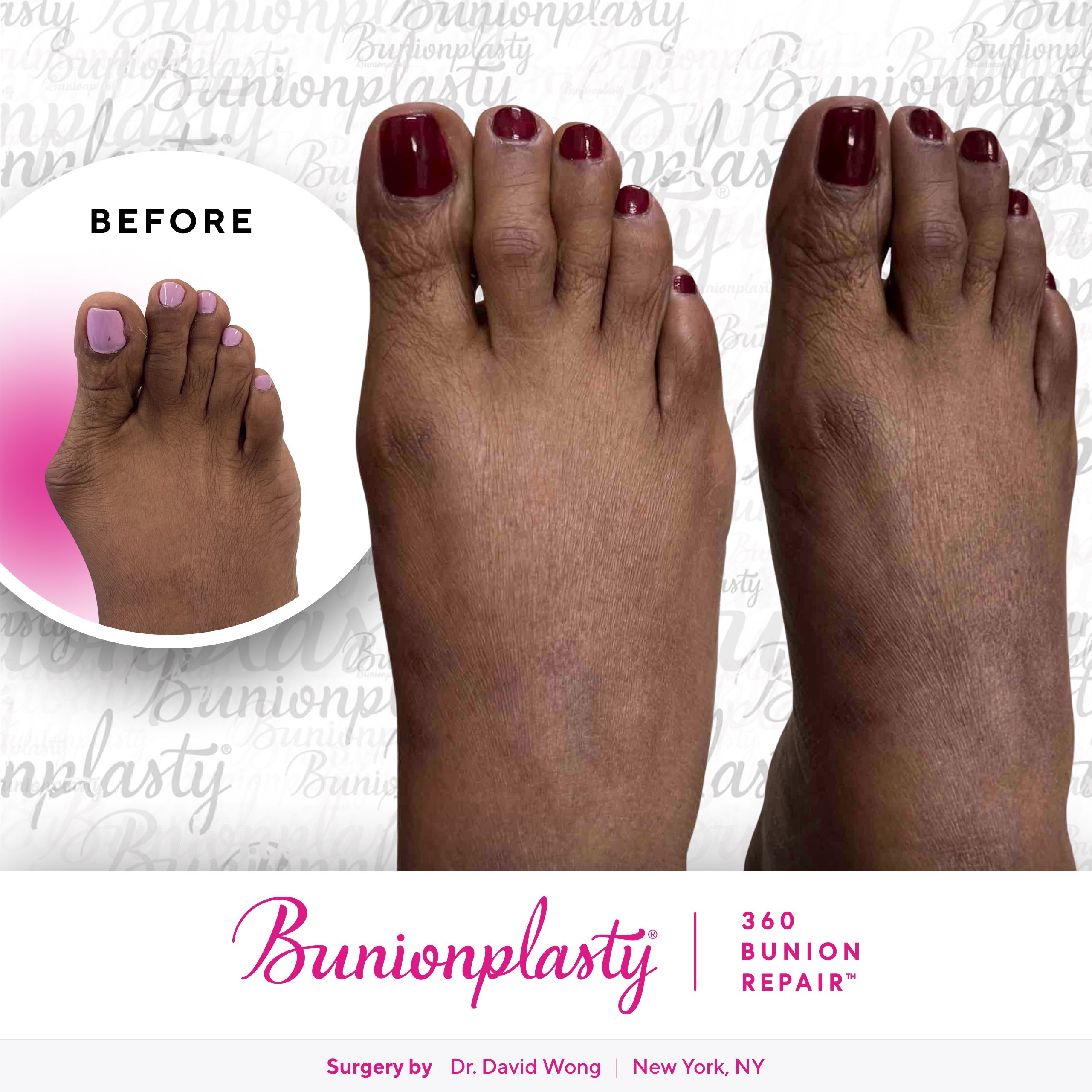 Bunionplasty® Before & After |  Dr. David Wong  |  Large Bunion  |  Right Foot