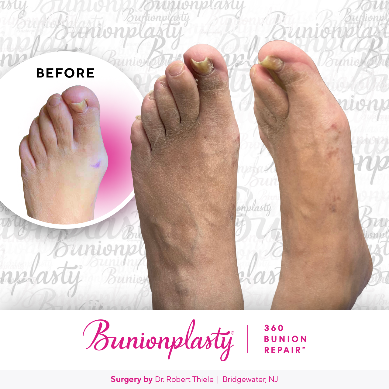 Bunionplasty® Before & After  |  Dr. Robert Thiele  |  Large Bunion  |  Left Foot