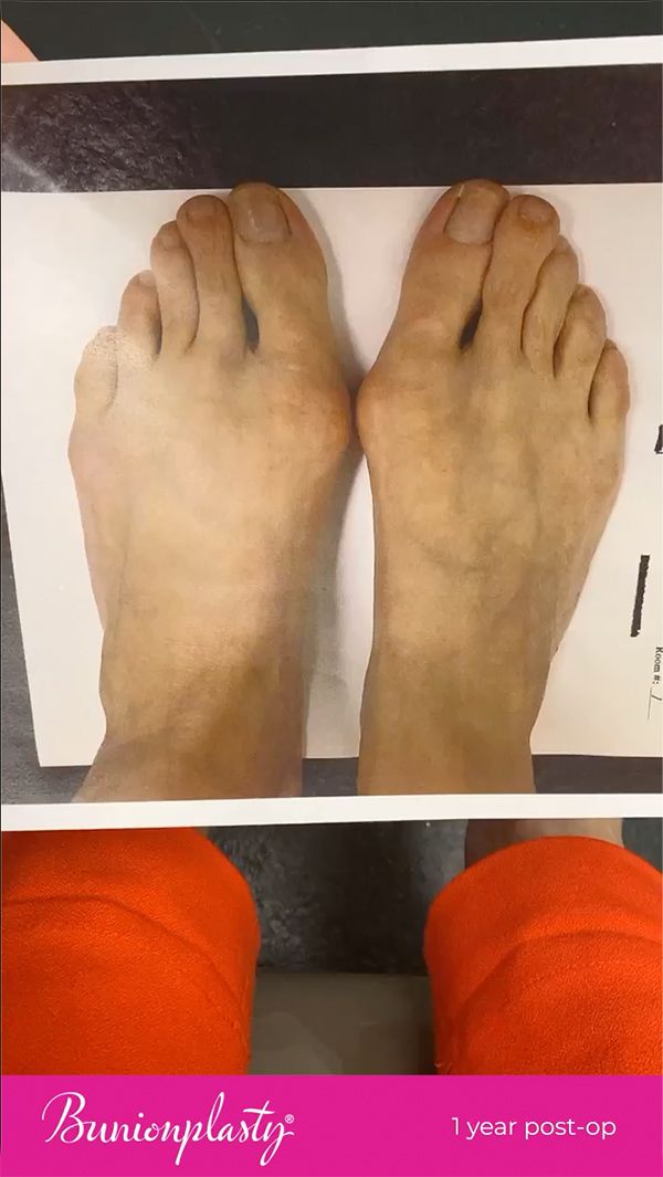 Patient Results Bunionplasty® 360 Repair™