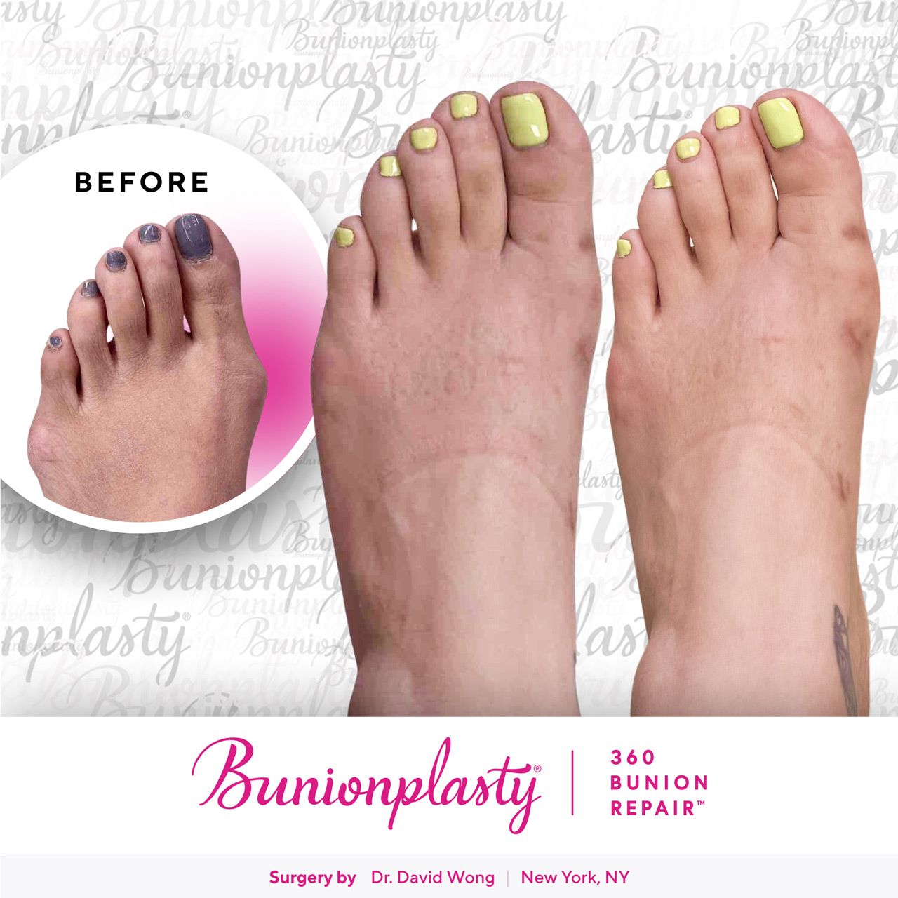 Bunionplasty® Before & After |  Dr. David Wong  |  Mild Bunion  |  Left Foot