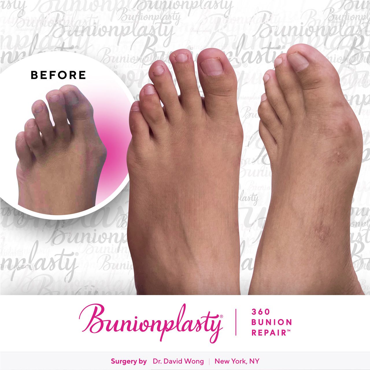 Bunionplasty® Before & After |  Severe Bunion  |  Left Foot