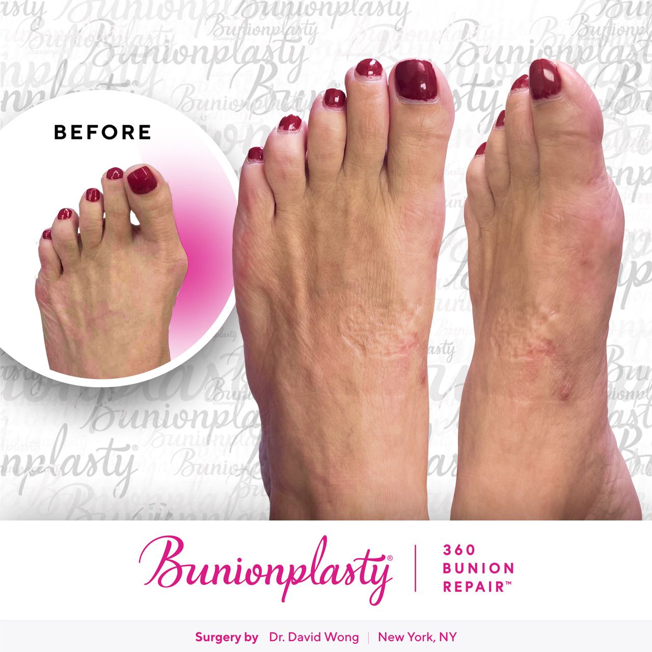 Bunionplasty® Before & After |  Dr. David Wong  |  Large Bunion  |  Left Foot