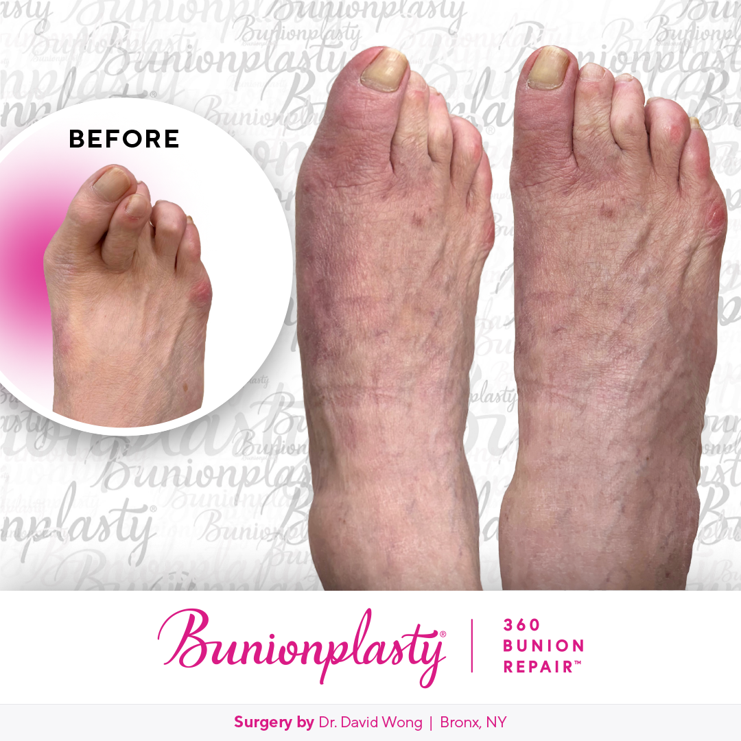 Bunionplasty® Before & After |  Dr. David Wong  |  Severe Bunion  |  Right Foot