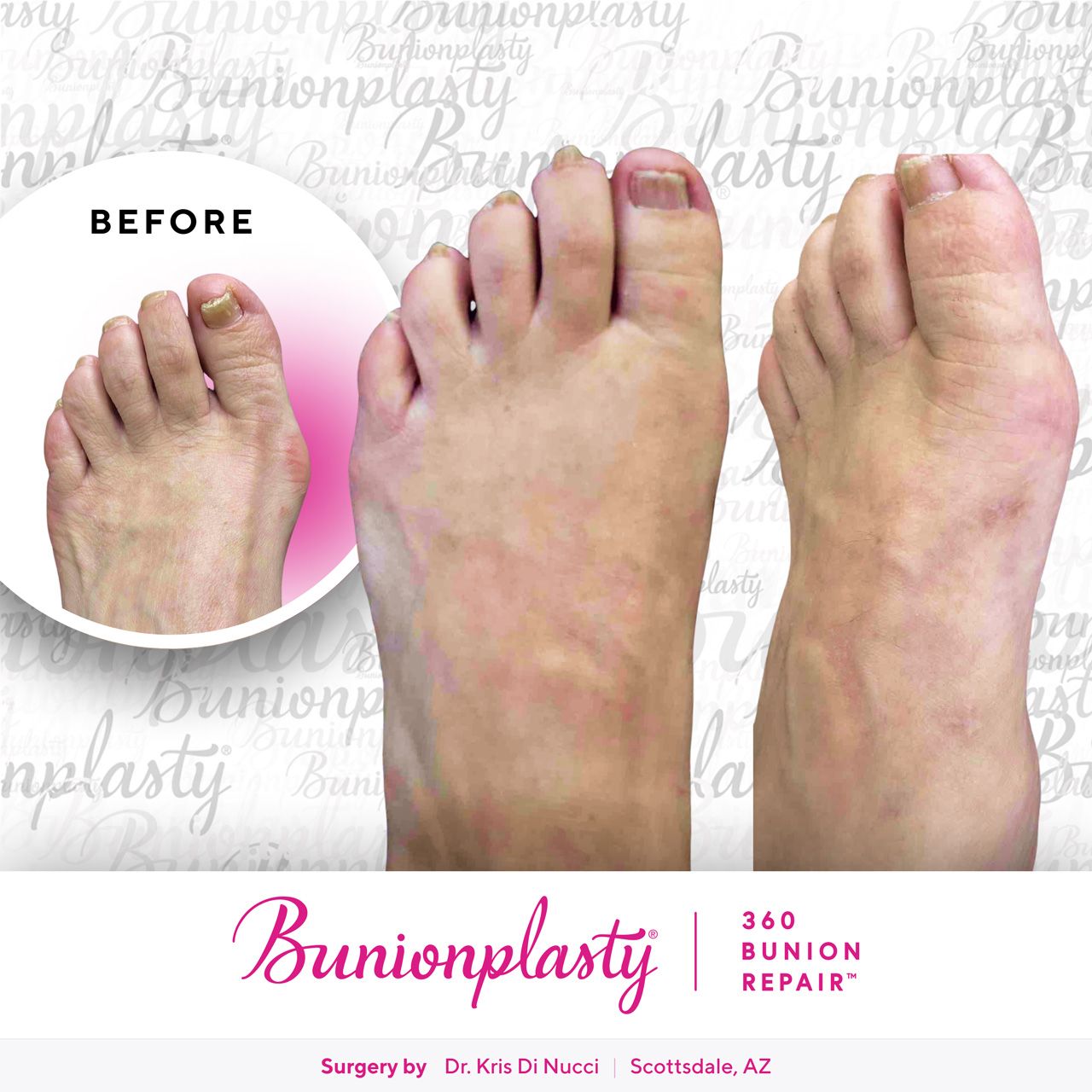 Bunionplasty® Before & After  |  Dr. Kris Di Nucci  |  Large Bunion  |  Left Foot