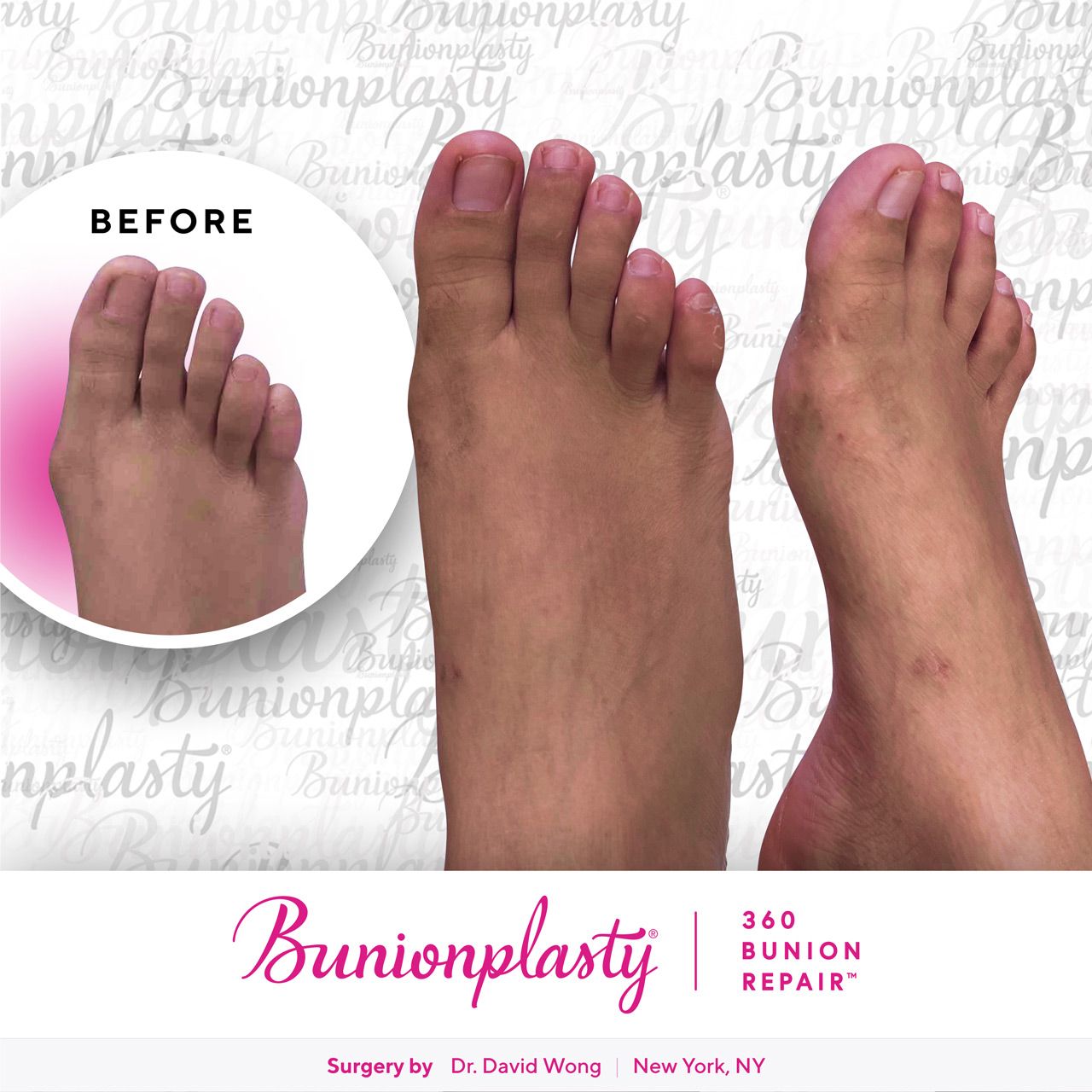 Bunionplasty® Before & After |  Mild Bunion  |  Right Foot