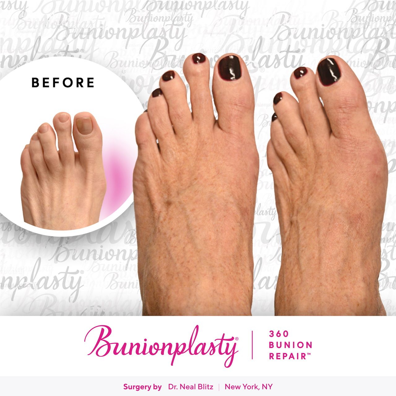 Bunionplasty® Before & After |  Mild Bunion  |  Left Foot