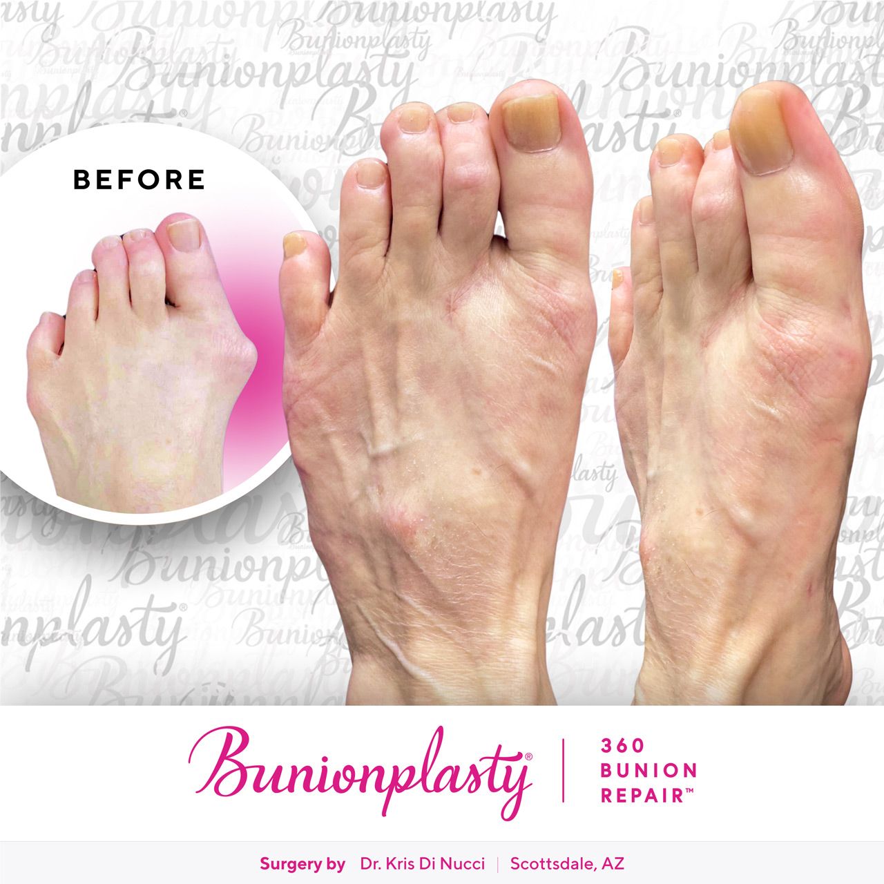 Bunionplasty® Before & After  |  Dr. Kris Di Nucci  |  Severe Bunion  |  Left Foot