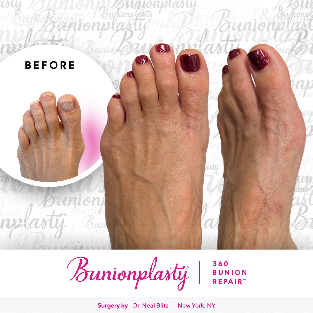 Bunionplasty® Before & After |  Small Bunion  |  Left Foot