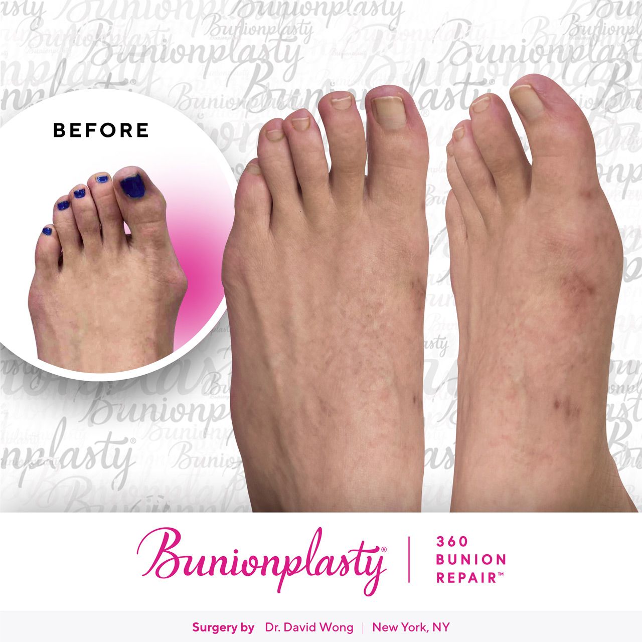 Bunionplasty® Before & After |  Dr. David Wong  |  Large Bunion  |  Left Foot