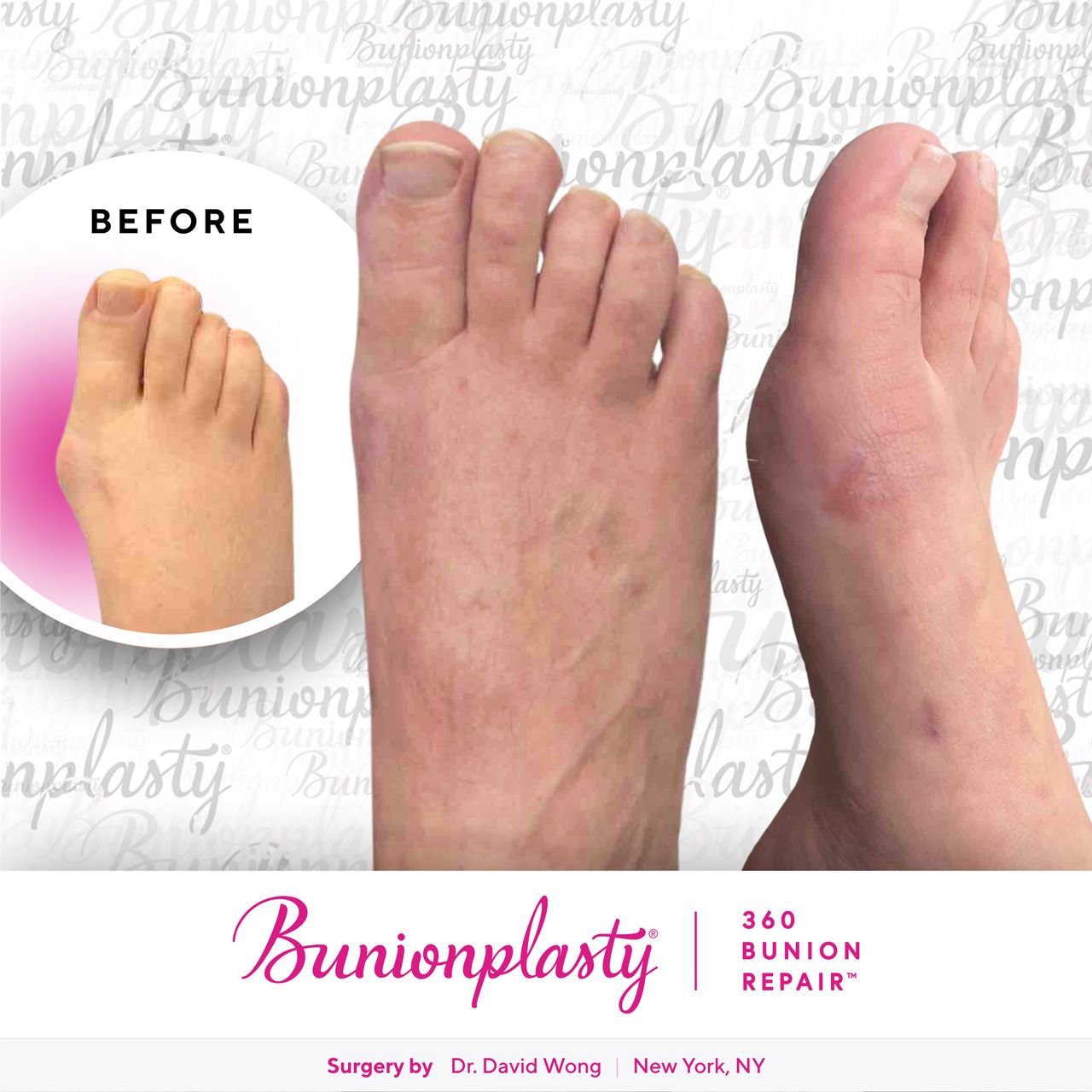 Bunionplasty® Before & After |  Mild Bunion  |  Right Foot