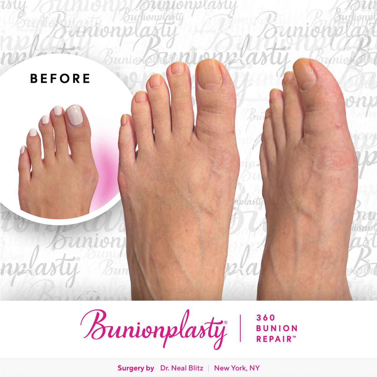 Bunionplasty® Before & After |  Mild Bunion  |  Left Foot