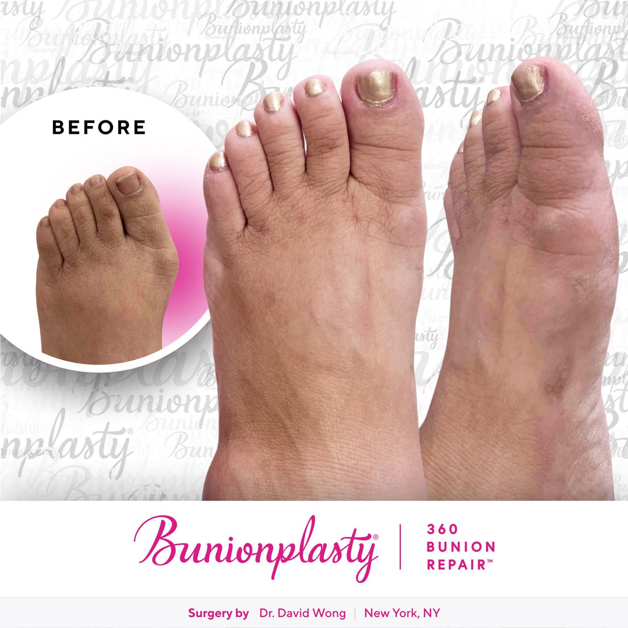 Bunionplasty® Before & After |  Large Bunion  |  Left Foot