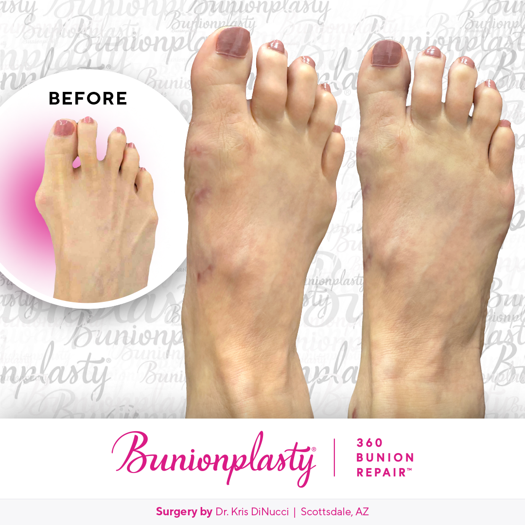 Bunionplasty® Before & After  |  Dr. Kris Di Nucci  |  Large Bunion  |  Right Foot