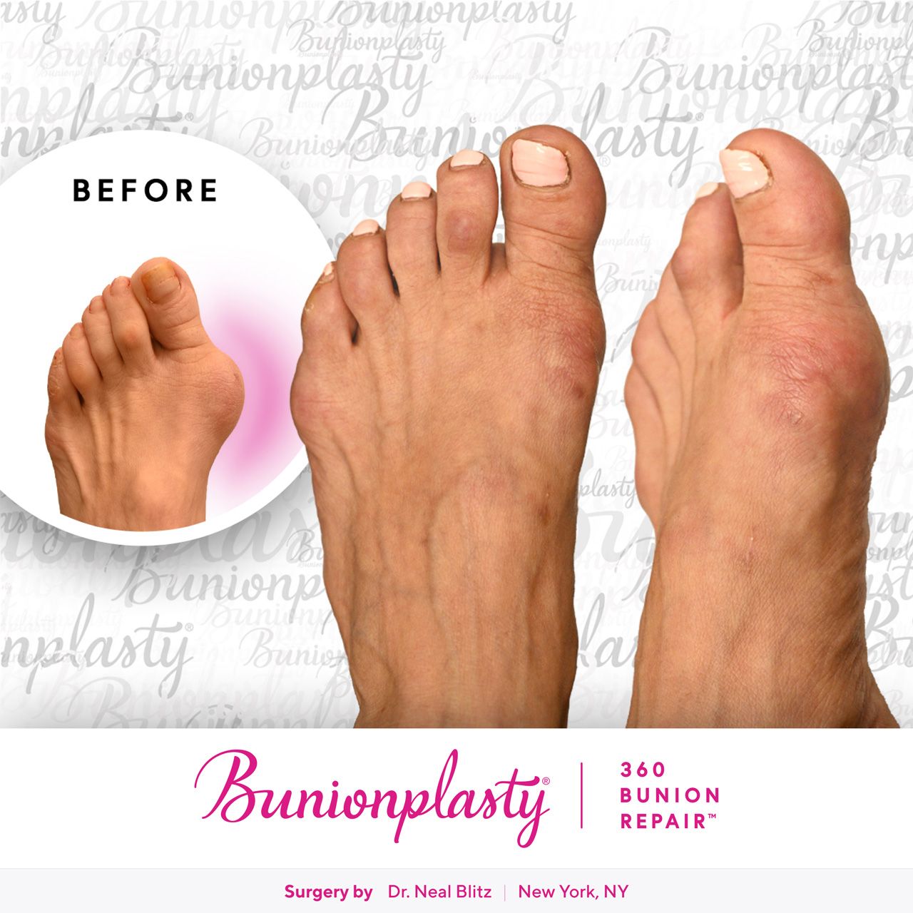 Bunionplasty® Before & After |  Severe Bunion  |  Left Foot