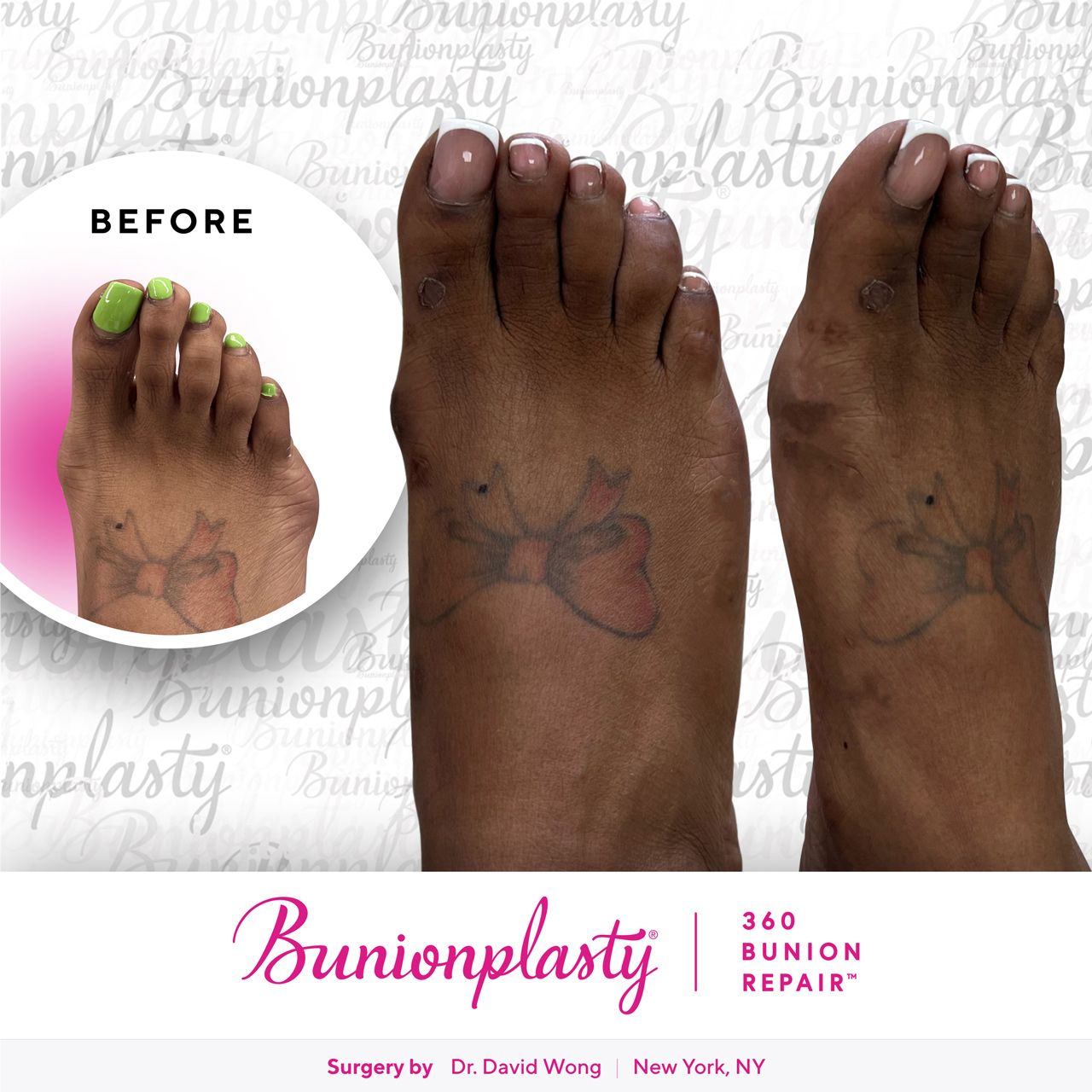 Bunionplasty® Before & After |  Dr. David Wong  |  Mild Bunion  |  Right Foot