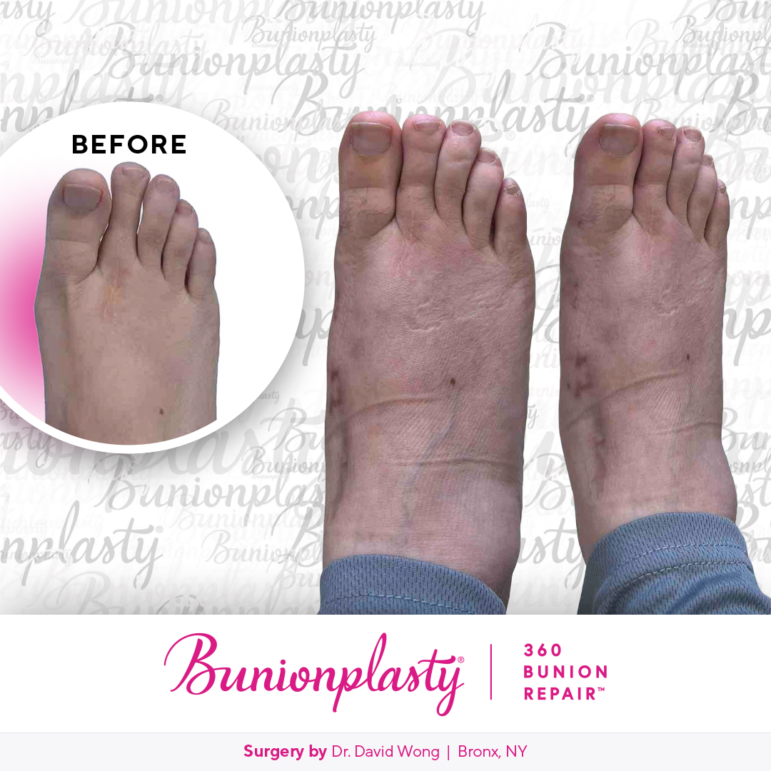 Bunionplasty® Before & After  |  Dr. David Wong |  Mild Bunion  |  Right Foot