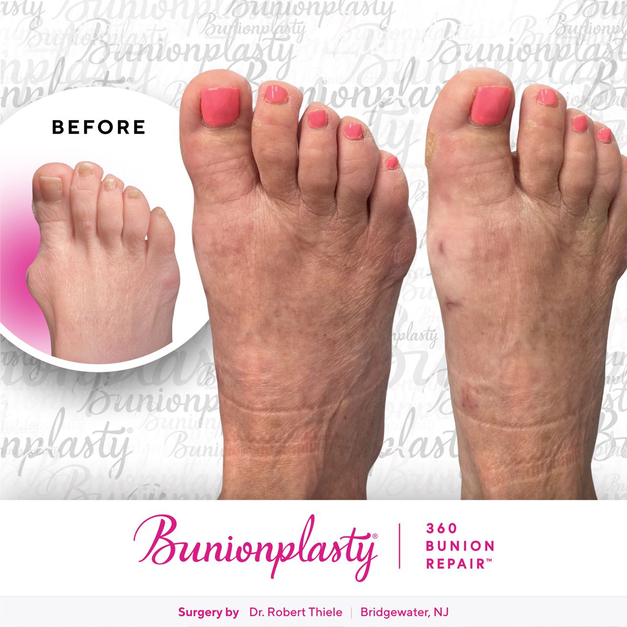 Bunionplasty® Before & After  |  Dr. Robert Thiele  |  Large Bunion  |  Right Foot