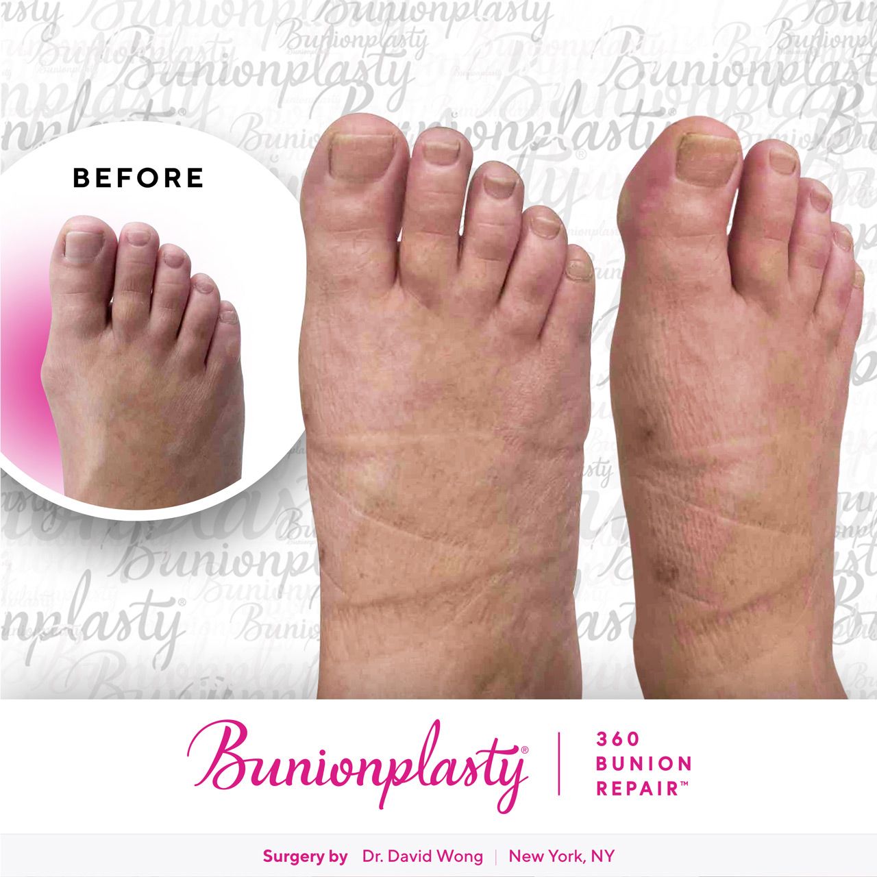 Bunionplasty® Before & After |  Mild Bunion  |  Right Foot