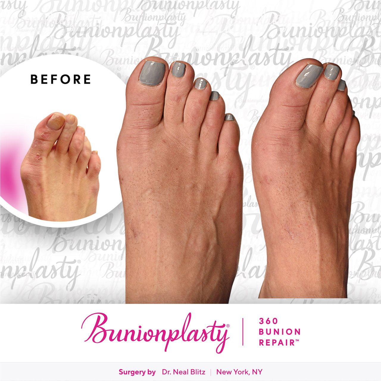 Bunionplasty® Before & After |  Large Bunion  |  Right Foot