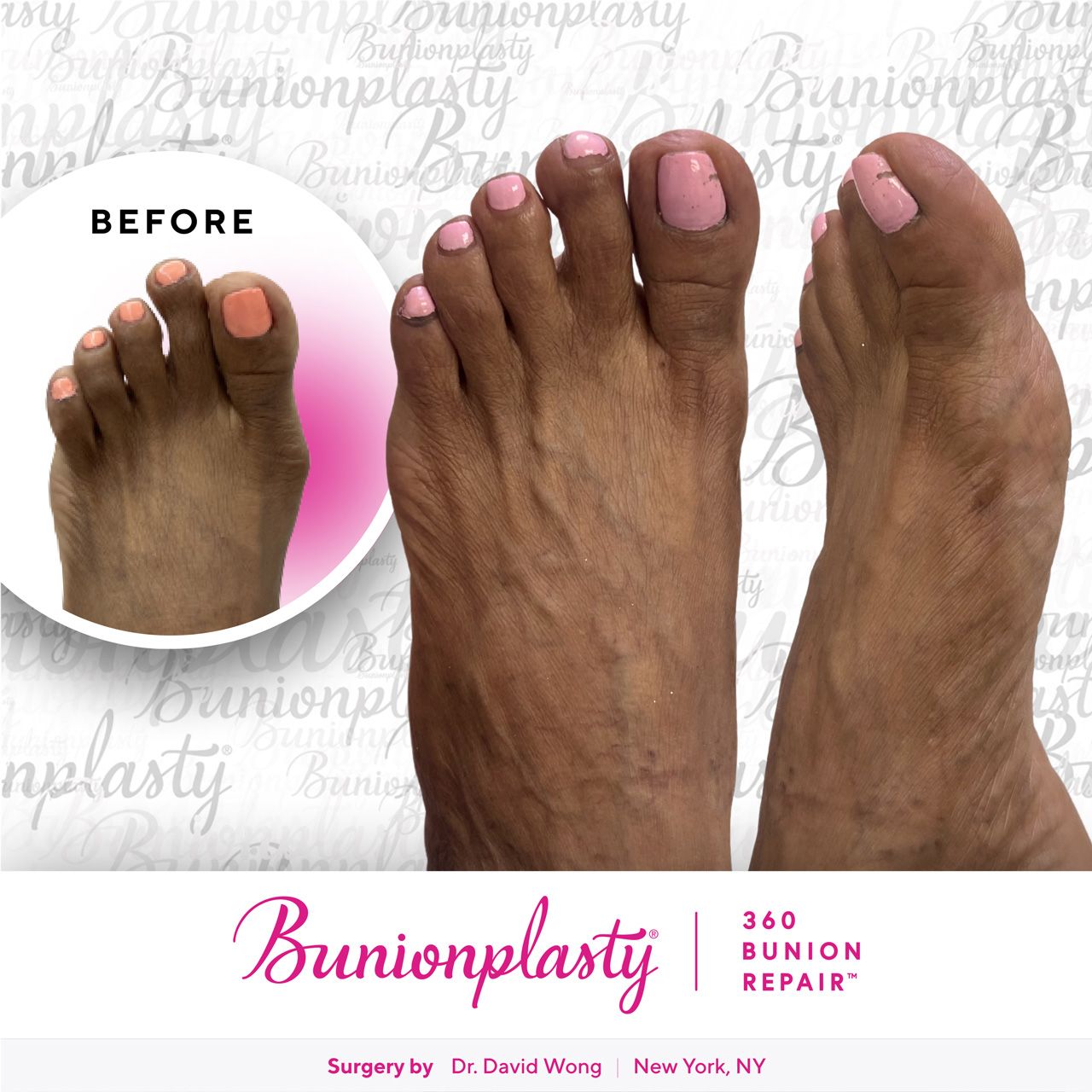 Bunionplasty® Before & After |  Mild Bunion  |  Left Foot